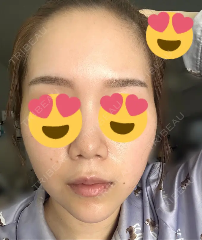 糸リフト / ヒアルロン酸注入（あご） / ボトックス（肩） TCB東京中央美容外科 心斎橋院 DAY 6 メイン用