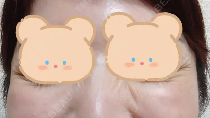 シワ取りボトックス / ボトックス（目尻） 湘南美容クリニック 川崎院 DAY 9 メイン用