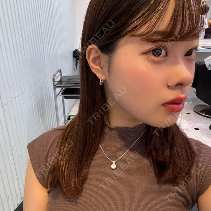 ヒアルロン酸注入（涙袋） 吉祥寺アイビークリニック AFTER メイン用