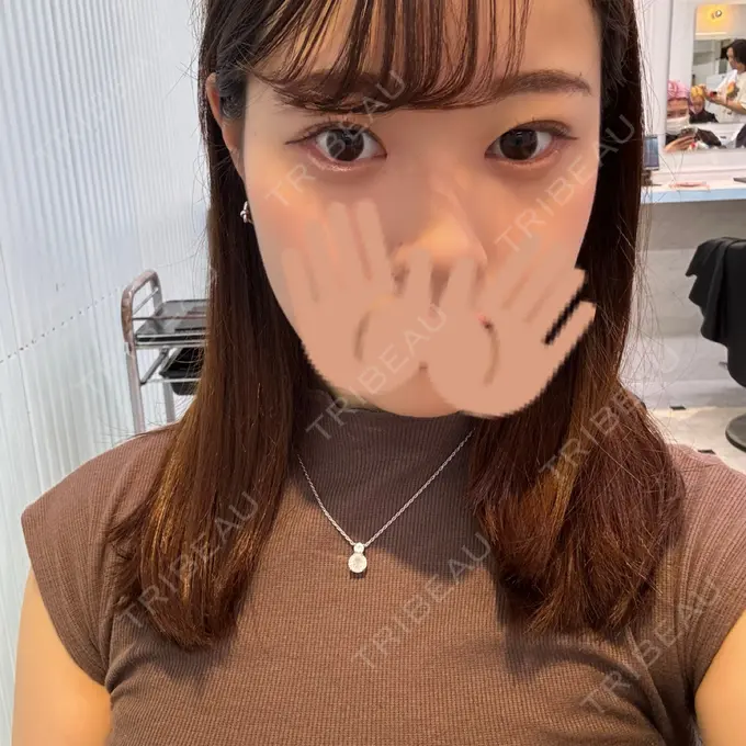 ヒアルロン酸注入（涙袋） 吉祥寺アイビークリニック DAY 1 メイン用