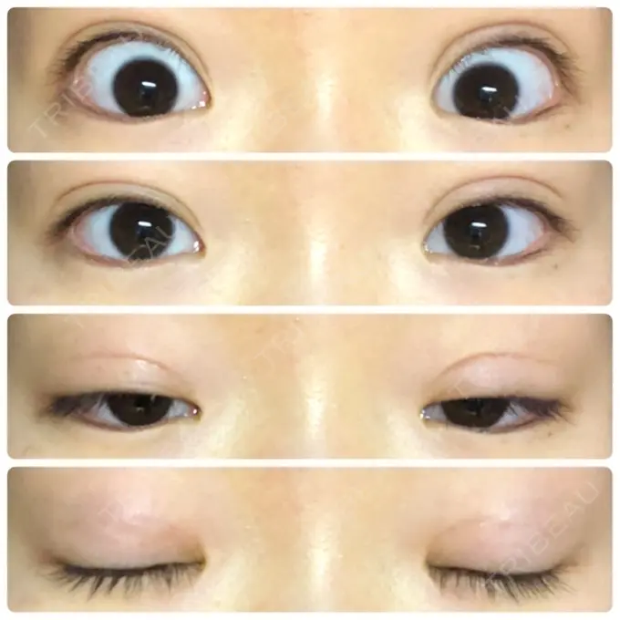 二重埋没 湘南美容クリニック 新宿本院 DAY 16 メイン用