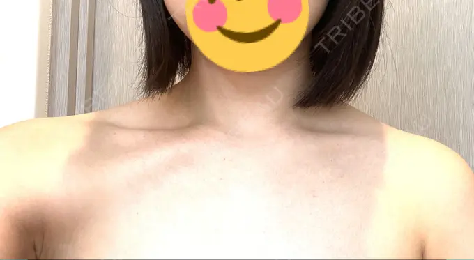 ボトックス（肩） MYCLINIC 西新宿 DAY 3 メイン用