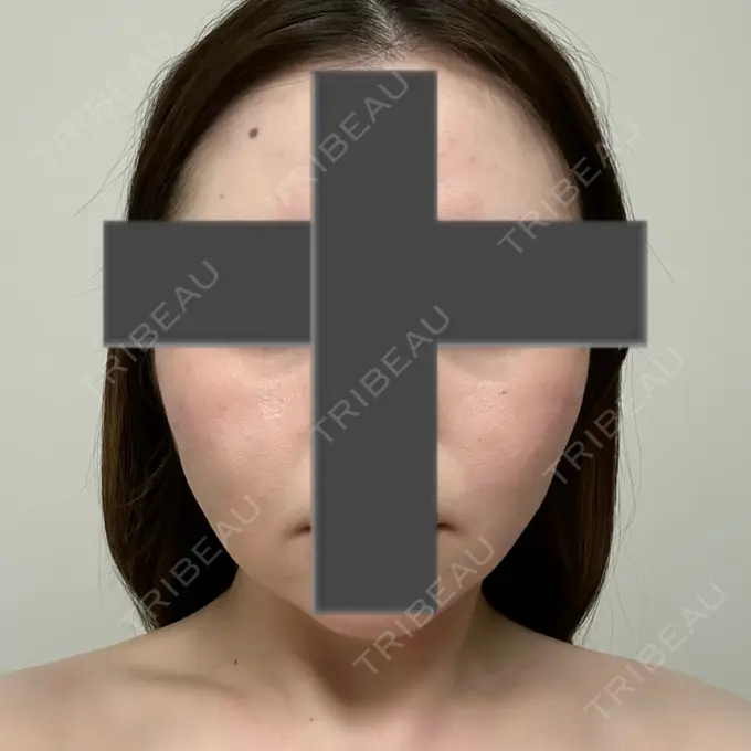 脂肪吸引（顔） / ジョールファット除去 / ヒアルロン酸注入（あご） / ボトックス（エラ・小顔） Otus Clinic 【オータスクリニック】 DAY 184 メイン用