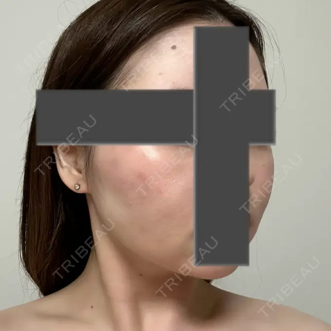 脂肪吸引（顔） / ジョールファット除去 / ヒアルロン酸注入（あご） / ボトックス（エラ・小顔） Otus Clinic 【オータスクリニック】 DAY 184 メイン用