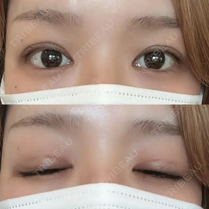 二重埋没 ルネッサンス美容外科医院 神戸院 DAY 3 メイン用