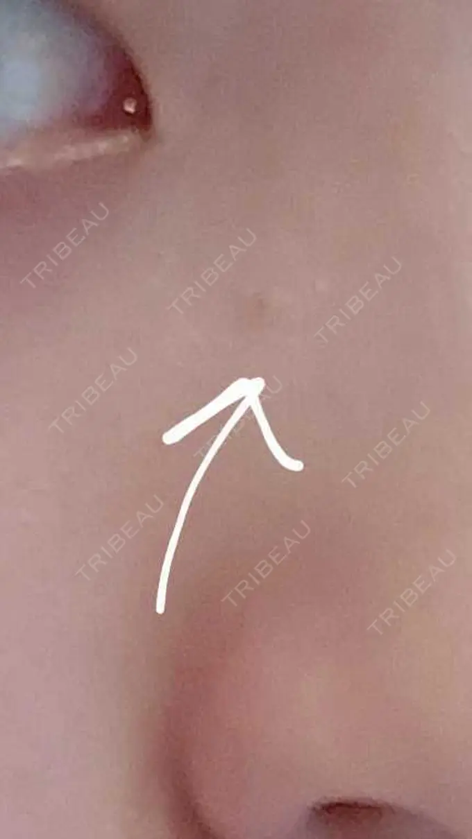 ほくろ・いぼ切除（肌） / ボトックス（エラ・小顔） 品川美容外科 渋谷院（※品川スキンクリニック提携） DAY 108 メイン用