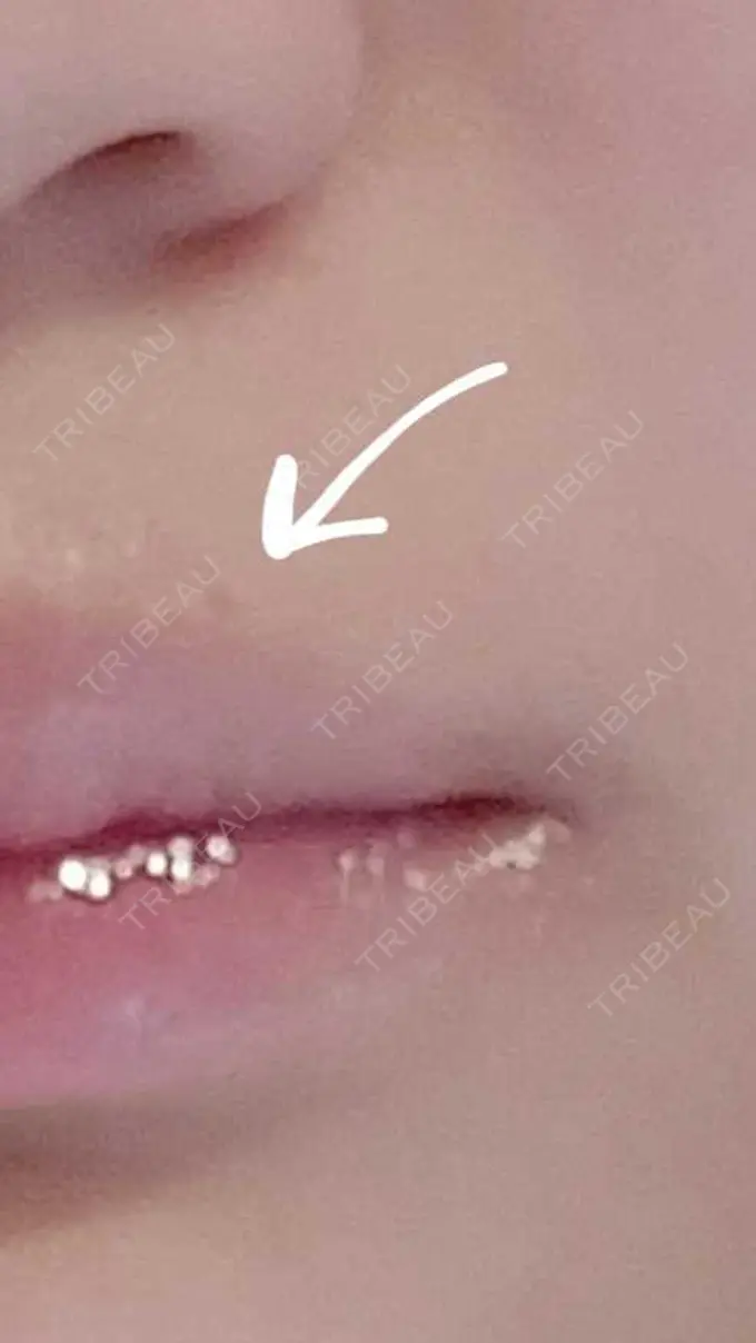 ほくろ・いぼ切除（肌） / ボトックス（エラ・小顔） 品川美容外科 渋谷院（※品川スキンクリニック提携） DAY 108 メイン用