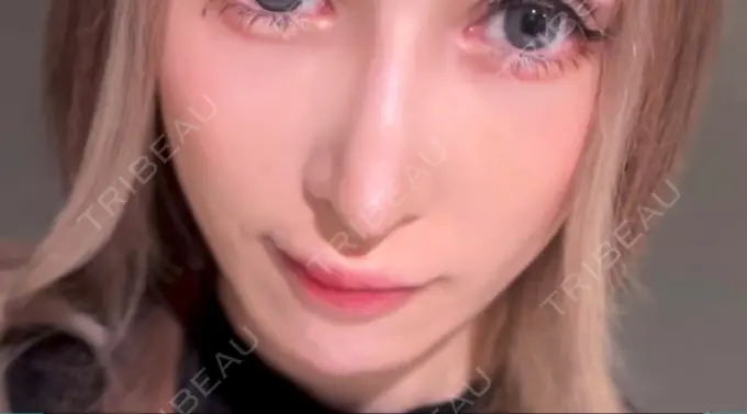 鼻尖形成（切開） / 軟骨移植 / 骨切幅寄せ / ワシ鼻修正・ハンプ切除 銀座マイアミ美容外科 DAY 34 メイン用