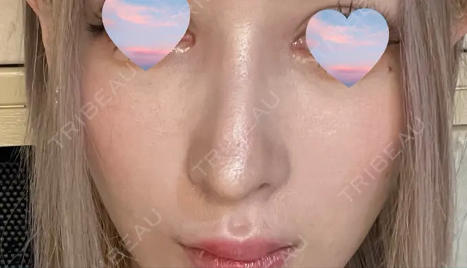 鼻尖形成（切開） / 軟骨移植 / 骨切幅寄せ / ワシ鼻修正・ハンプ切除 銀座マイアミ美容外科 DAY 34 メイン用