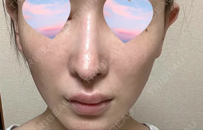 鼻尖形成（切開） / 軟骨移植 / 骨切幅寄せ / ワシ鼻修正・ハンプ切除 銀座マイアミ美容外科 DAY 34 メイン用