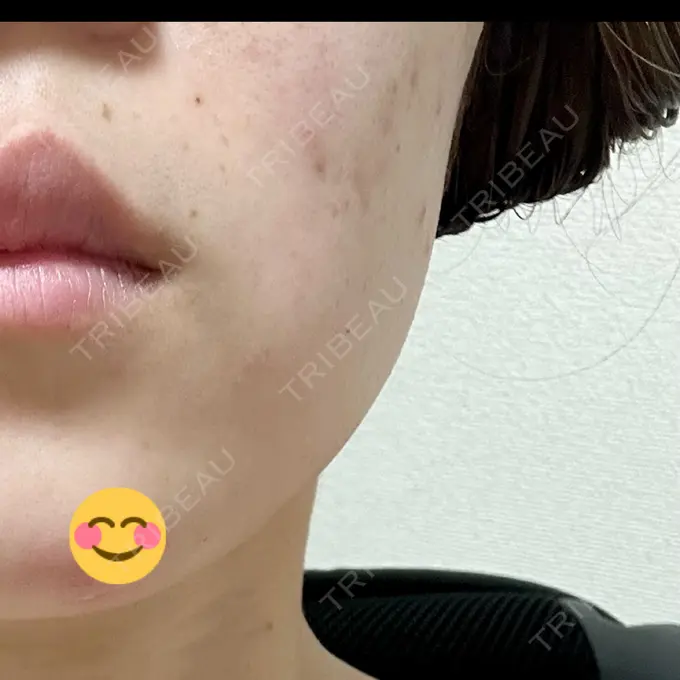 ボトックス（エラ・小顔） 共立美容外科 立川院 DAY 13 メイン用