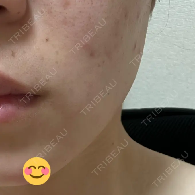 ボトックス（エラ・小顔） 共立美容外科 立川院 AFTER メイン用