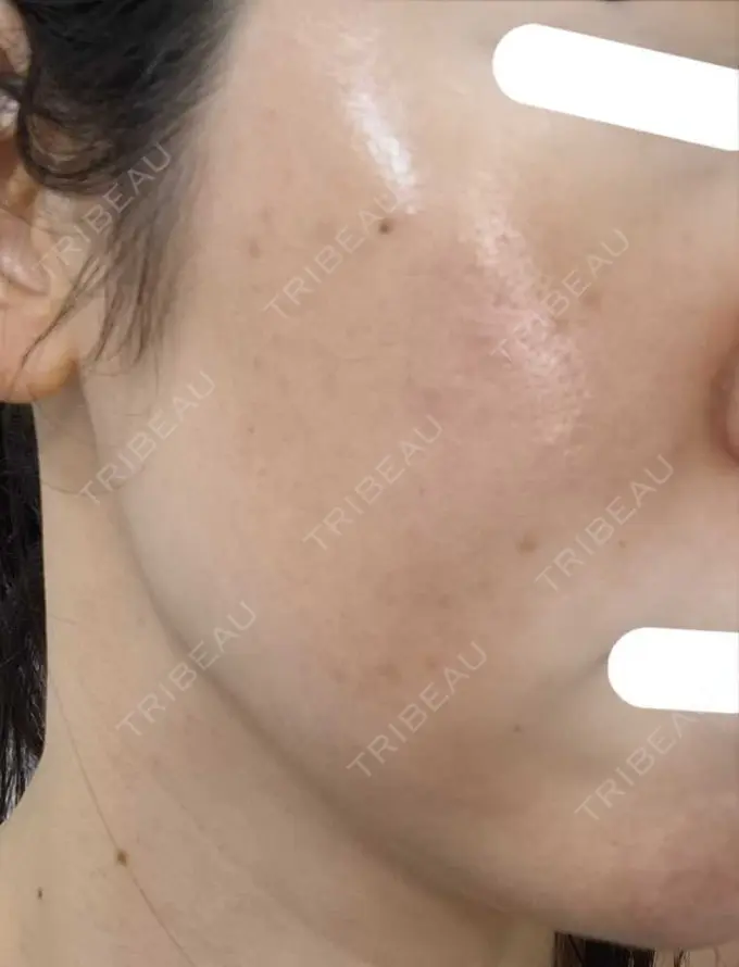 光治療（フォトフェイシャルなど） B-leafメディカル内科小児科クリニック DAY 1 メイン用