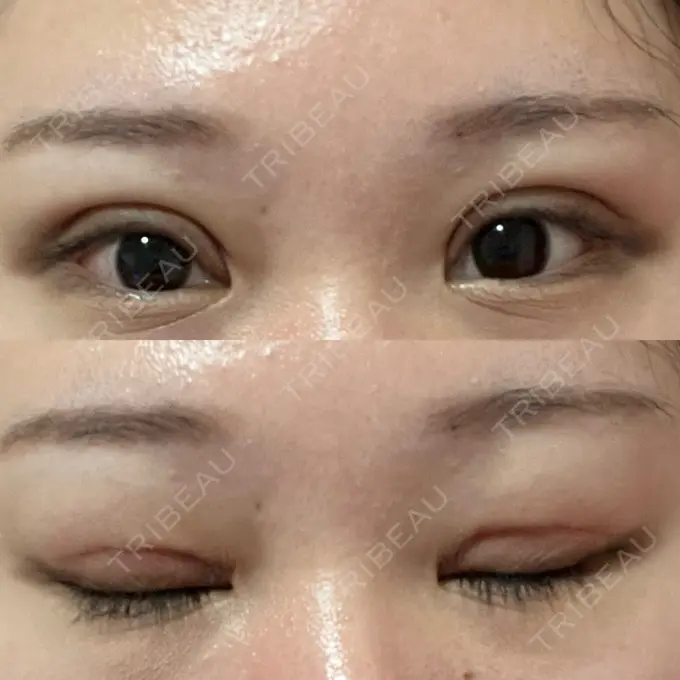 二重切開 / 眼瞼下垂（切開） エターナル美容クリニック DAY 20 メイン用