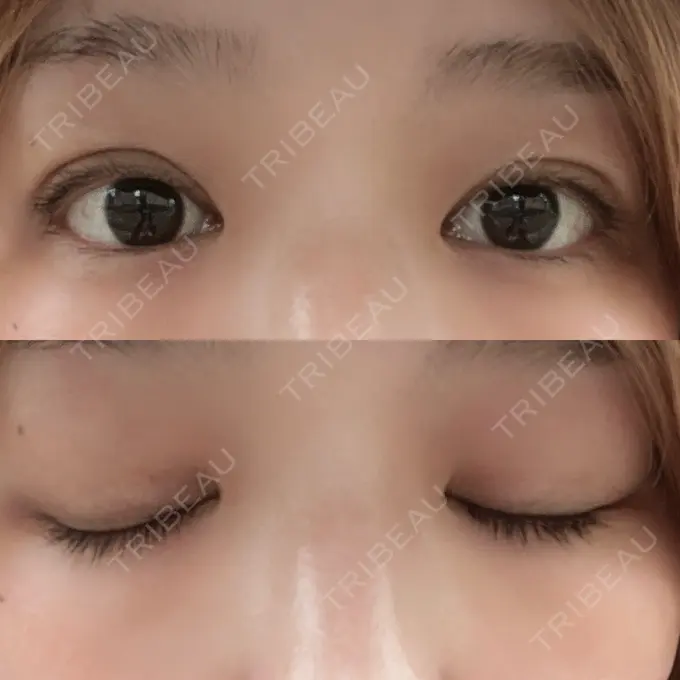 二重埋没 ルネッサンス美容外科医院 神戸院 DAY 4 メイン用