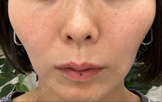 RF（高周波）たるみ治療 東京美容医療クリニック 池袋院 AFTER メイン用