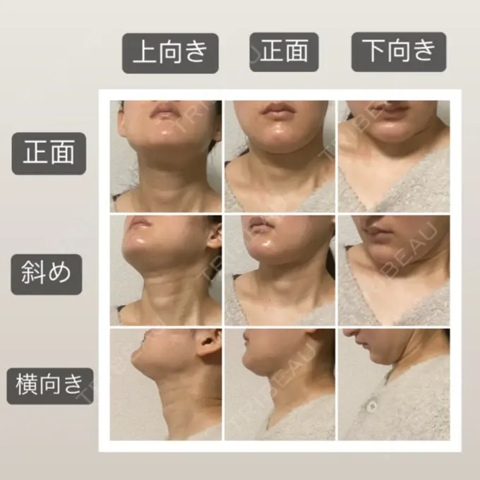 脂肪吸引（顔） 湘南美容クリニック 秋葉原院 DAY 42 メイン用