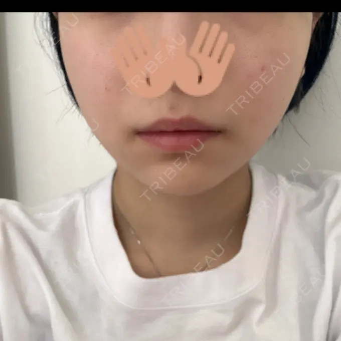 赤み除去レーザー ziz CLINIC DAY 1 メイン用