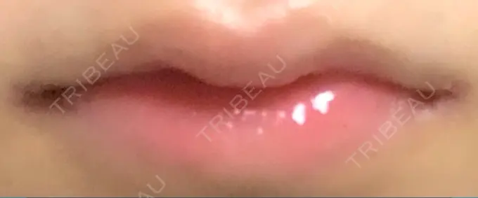 口角挙上 LOUIS CLINIC 二子玉川院【ルイクリニック】 AFTER メイン用