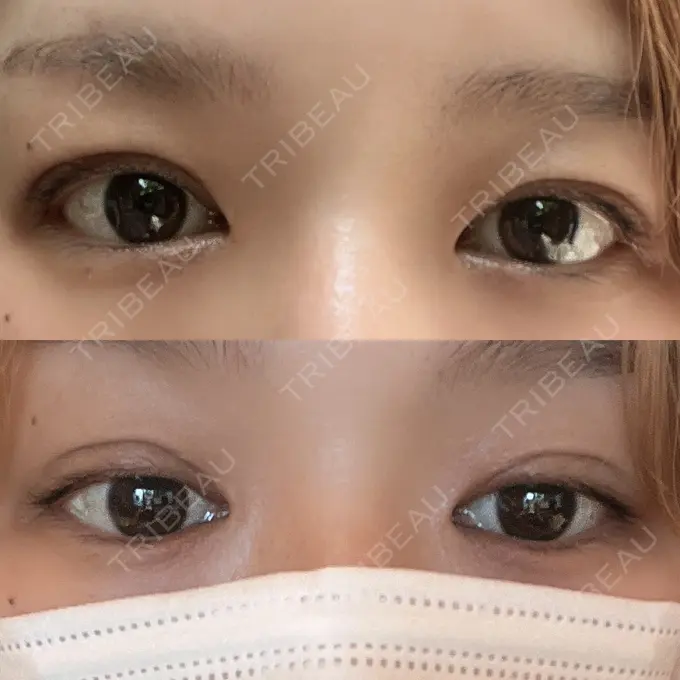 二重埋没 ルネッサンス美容外科医院 神戸院 DAY 5 メイン用