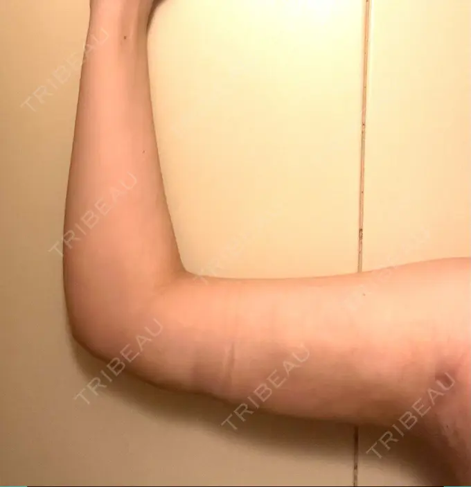 脂肪吸引（二の腕） アムルーズ美容外科クリニック 横浜院 DAY 23 メイン用