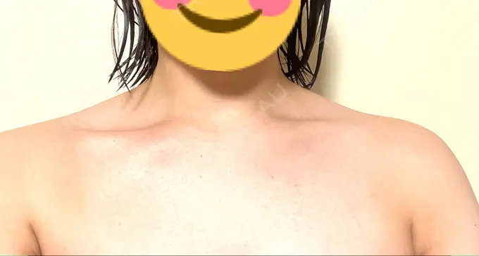 ボトックス（肩） MYCLINIC 西新宿 DAY 5 メイン用