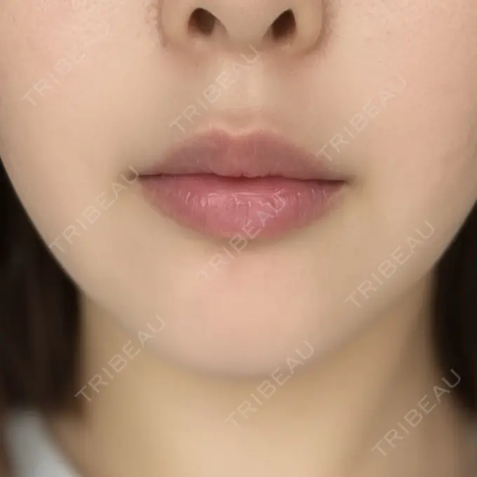 ヒアルロン酸注入（唇） ziz CLINIC DAY 4 メイン用