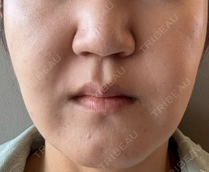 脂肪吸引（顔） スノウ（Snow）整形外科 DAY 34 メイン用