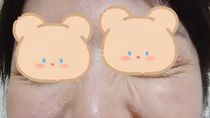 シワ取りボトックス / ボトックス（目尻） 湘南美容クリニック 川崎院 DAY 13 メイン用