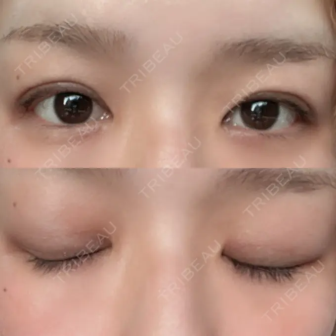 二重埋没 ルネッサンス美容外科医院 神戸院 DAY 6 メイン用