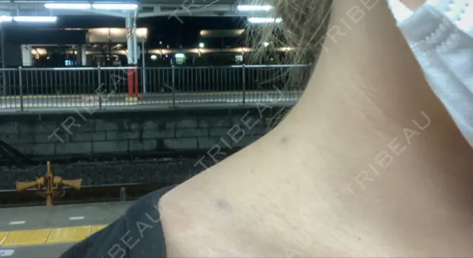 ボトックス（肩） DMTC美容皮膚科 大宮院 DAY 0 メイン用