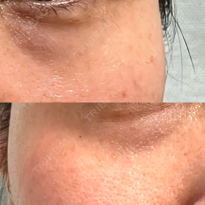 リジュラン 湘南美容クリニック 新宿南口院 DAY 6 メイン用