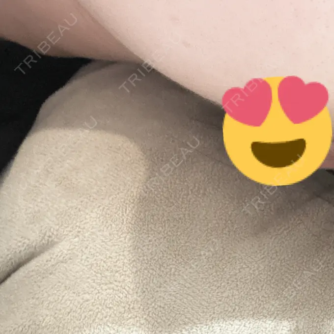 ボトックス（エラ・小顔） フィラークリニック 名古屋栄院 AFTER メイン用