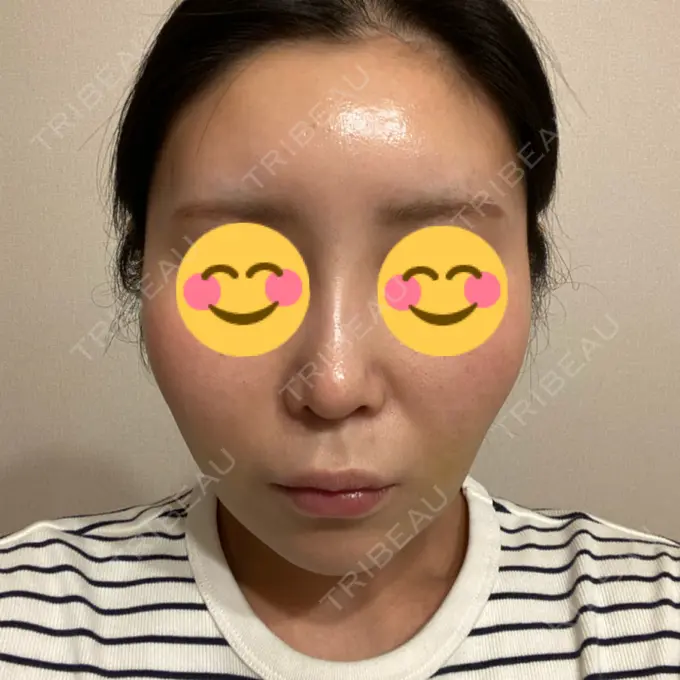 糸リフト / 脂肪吸引注射（顔） 湘南美容クリニック 川崎院 AFTER メイン用