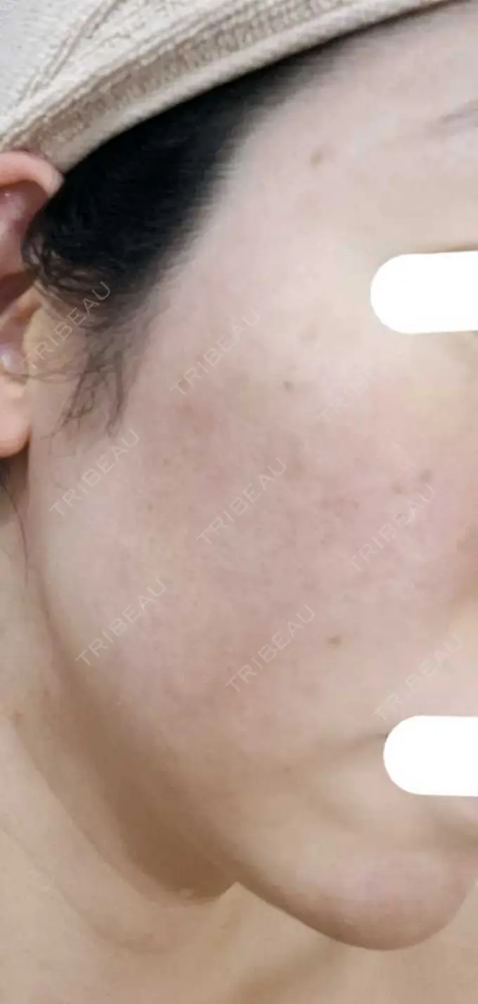 光治療（フォトフェイシャルなど） B-leafメディカル内科小児科クリニック DAY 3 メイン用