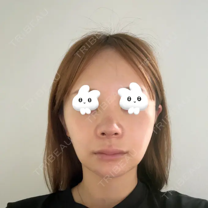 隆鼻術 / 鼻尖形成（切開） / 鼻中隔延長（切開） / 軟骨移植 / 鼻修正 / 鼻孔縁下降 / その他（鼻） Designo Clinic （デジーノクリニック） DAY 9 メイン用