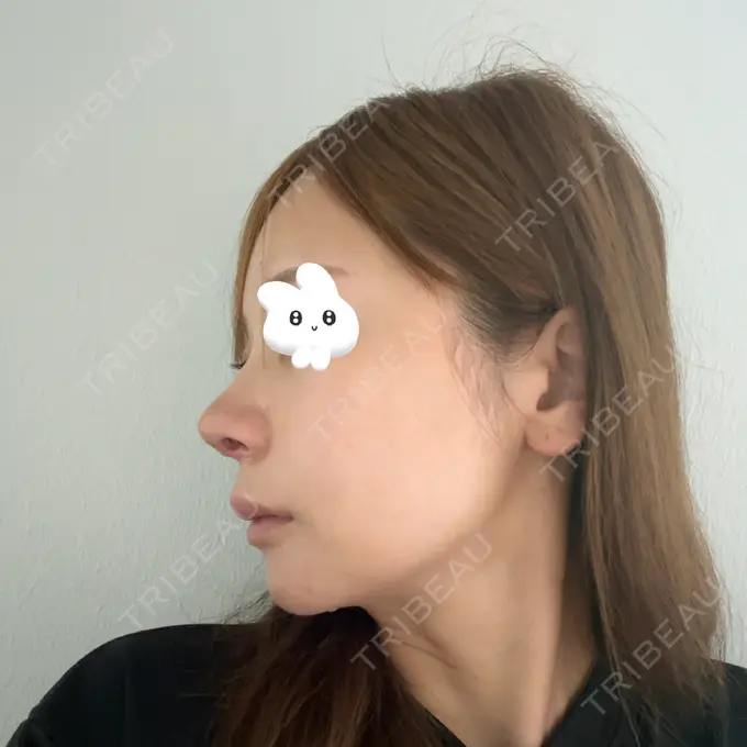 隆鼻術 / 鼻尖形成（切開） / 鼻中隔延長（切開） / 軟骨移植 / 鼻修正 / 鼻孔縁下降 / その他（鼻） Designo Clinic （デジーノクリニック） DAY 9 メイン用