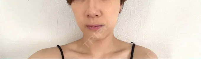 ボトックス（エラ・小顔） ルラ美容クリニック 広島院 DAY 3 メイン用