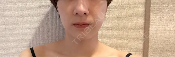 ボトックス（エラ・小顔） ルラ美容クリニック 広島院 DAY 6 メイン用