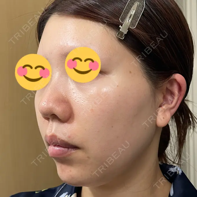 水光注射（ハリ・美肌） / その他（肌） / ピーリング（ニキビ・毛穴） / RF（高周波）たるみ治療 / その他（目元） / その他（鼻） バログ医院 江南院 DAY 7 メイン用