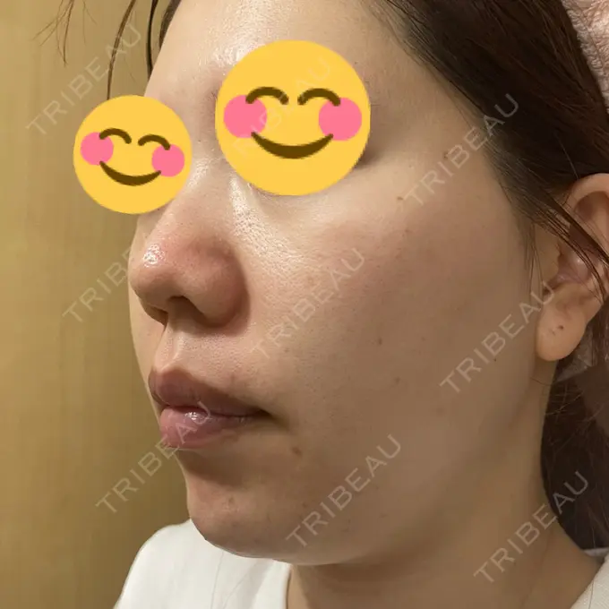 水光注射（ハリ・美肌） / その他（肌） / ピーリング（ニキビ・毛穴） / RF（高周波）たるみ治療 / その他（目元） / その他（鼻） バログ医院 江南院 DAY 8 メイン用