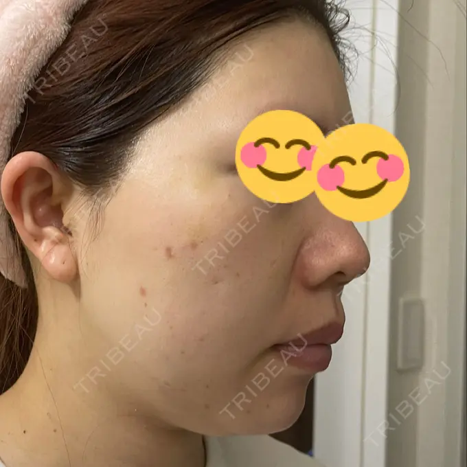 水光注射（ハリ・美肌） / その他（肌） / ピーリング（ニキビ・毛穴） / RF（高周波）たるみ治療 / その他（目元） / その他（鼻） バログ医院 江南院 DAY 8 メイン用