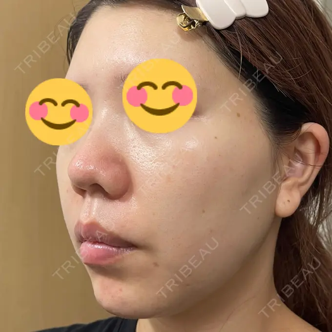 水光注射（ハリ・美肌） / その他（肌） / ピーリング（ニキビ・毛穴） / RF（高周波）たるみ治療 / その他（目元） / その他（鼻） バログ医院 江南院 DAY 9 メイン用