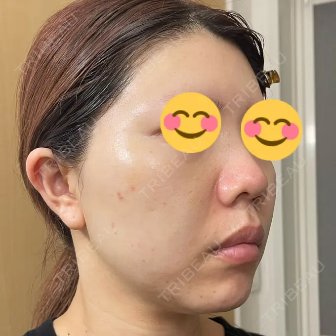 水光注射（ハリ・美肌） / その他（肌） / ピーリング（ニキビ・毛穴） / RF（高周波）たるみ治療 / その他（目元） / その他（鼻） バログ医院 江南院 DAY 9 メイン用