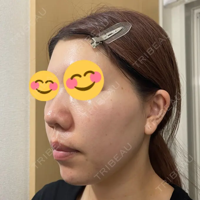 水光注射（ハリ・美肌） / その他（肌） / ピーリング（ニキビ・毛穴） / RF（高周波）たるみ治療 / その他（目元） / その他（鼻） バログ医院 江南院 DAY 10 メイン用