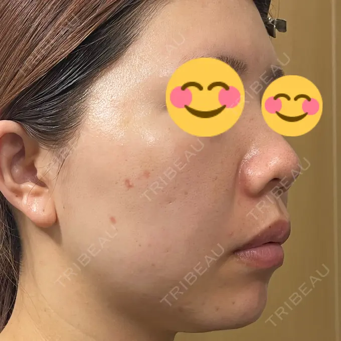 水光注射（ハリ・美肌） / その他（肌） / ピーリング（ニキビ・毛穴） / RF（高周波）たるみ治療 / その他（目元） / その他（鼻） バログ医院 江南院 DAY 10 メイン用