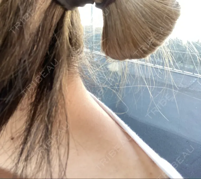 ボトックス（肩） DMTC美容皮膚科 大宮院 DAY 1 メイン用