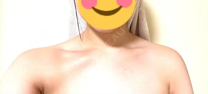 ボトックス（肩） MYCLINIC 西新宿 DAY 6 メイン用