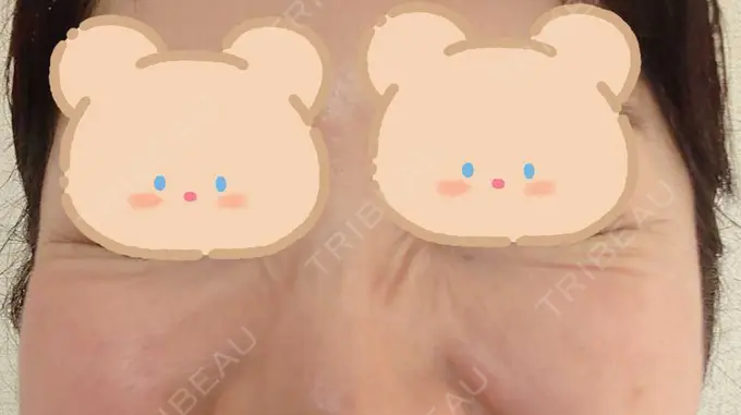 シワ取りボトックス / ボトックス（目尻） 湘南美容クリニック 川崎院 DAY 14 メイン用