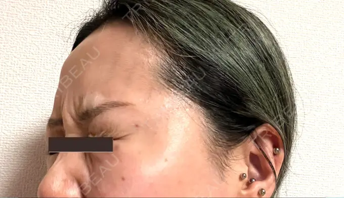 ボトックス（エラ・小顔） / ボトックス（眉間） / ボトックス（目尻） / ボトックス（額） 川越TAクリニックアソシエ DAY 1 メイン用